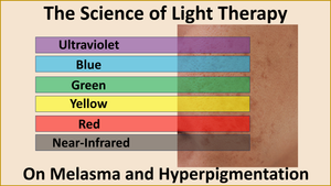 The Science of Light Therapy on Melasma and Hyperpigmentation